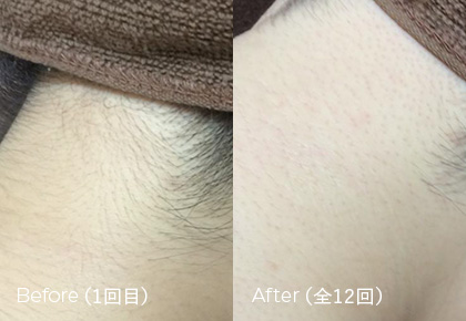 Before（1回目） After（全12回目）